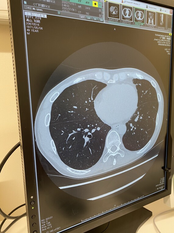 発熱外来での肺のCT画像