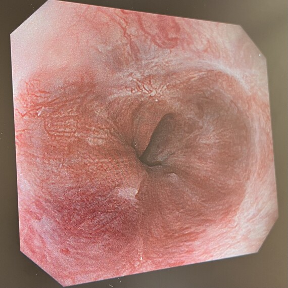 食道静脈瘤の内視鏡画像2