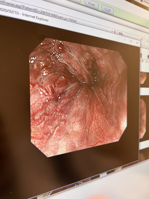 食道静脈瘤の内視鏡画像3