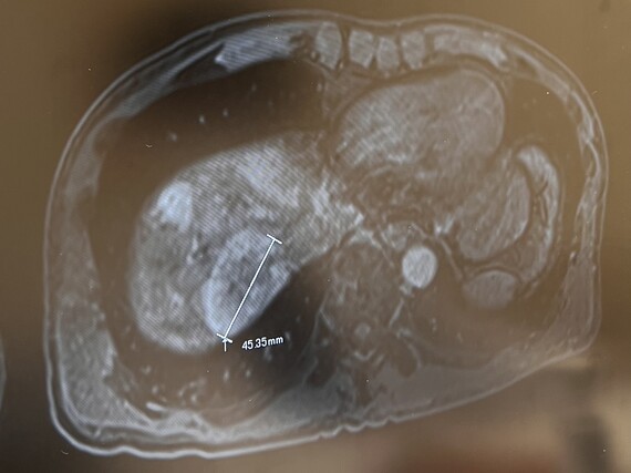 肝臓のMRI画像