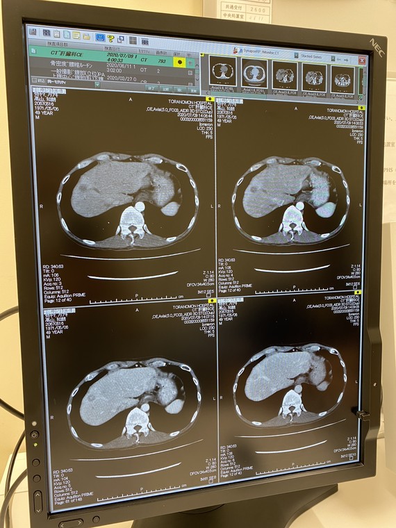 肝臓の造影CT画像