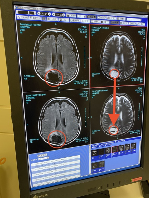異常の見つかった脳のMRI画像