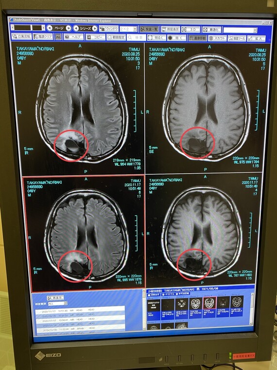 脳のMRI画像：水が溜まっている