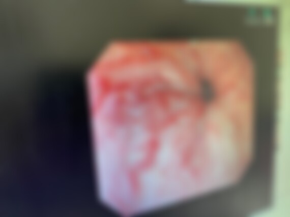 食道静脈瘤の内視鏡写真（ぼかし）