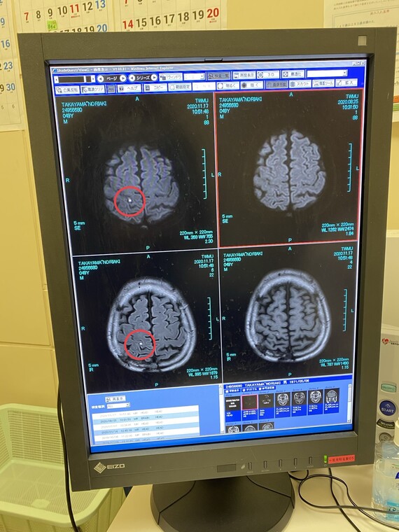 MRIに写った脳梗塞