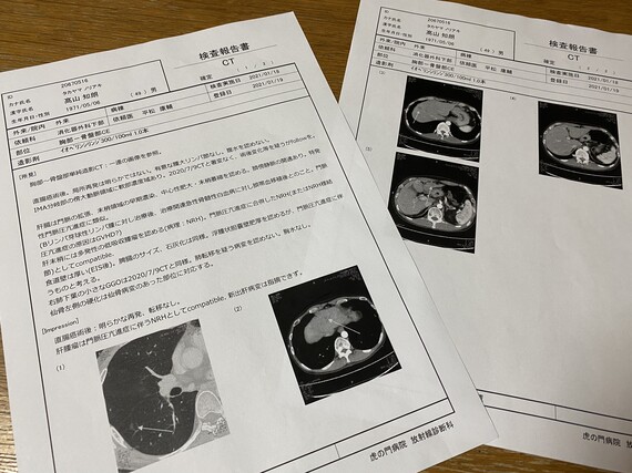 肝臓のCT検査の報告書