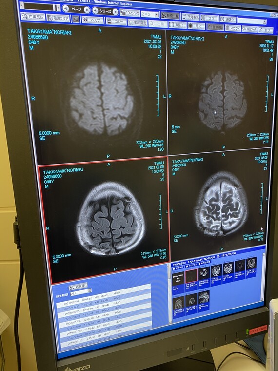 脳MRI202102