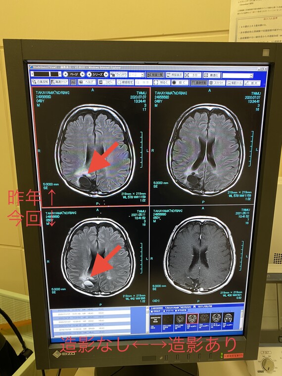 脳のMRI 書き込みあり 20210511