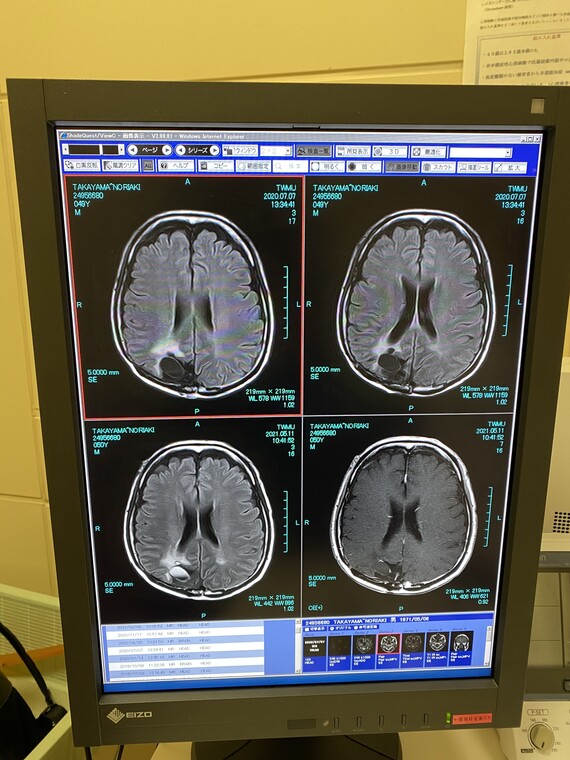 脳のMRI 20210511