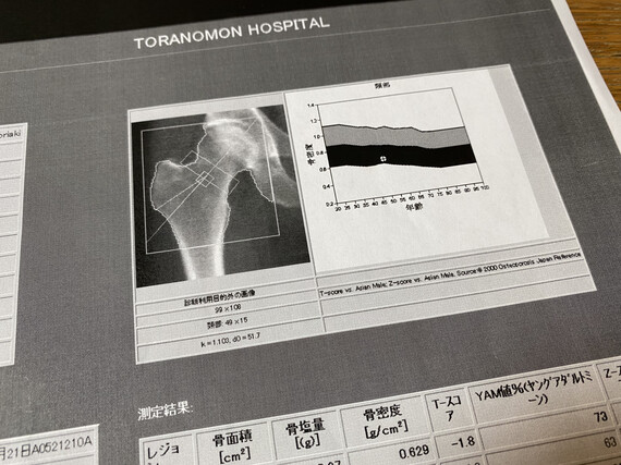  大腿骨骨密度検査