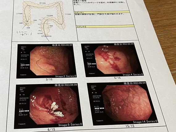 大腸ポリープ切除