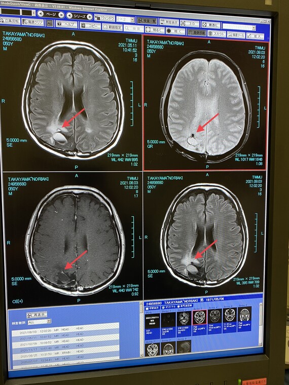脳のMRI画像20210803mu