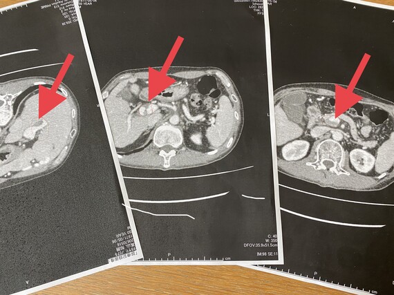 門脈血栓症 CT画像