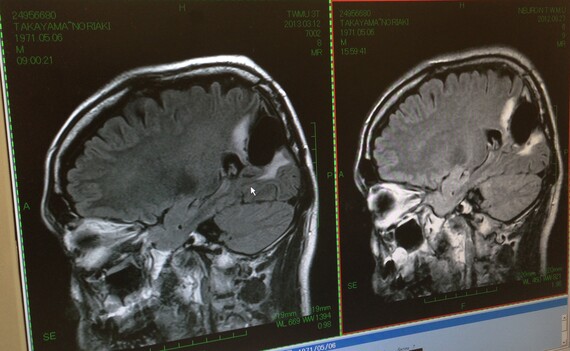 braintumor_mri.jpg