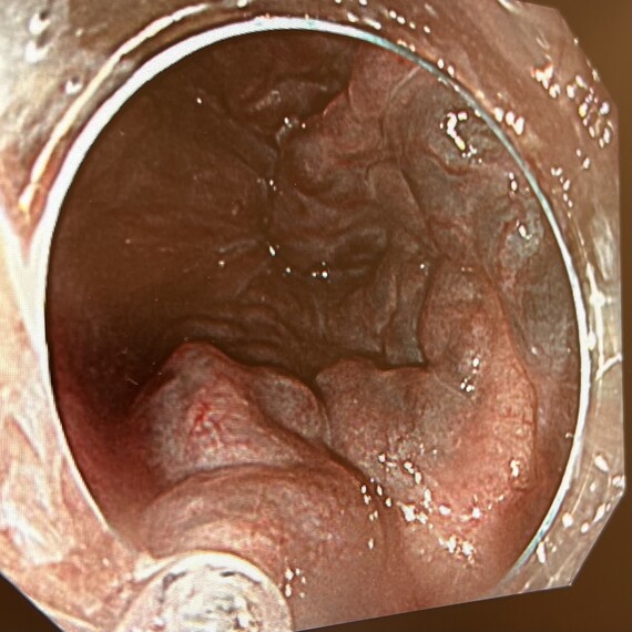 食道静脈瘤の内視鏡画像4