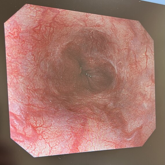 食道静脈瘤の内視鏡画像1