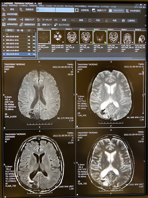 脳のMRI画像20220208
